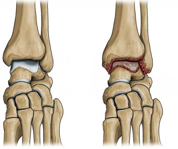 Artrosi dell'articolazione della caviglia