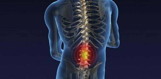 Mal di schiena con osteocondosi della colonna lombare