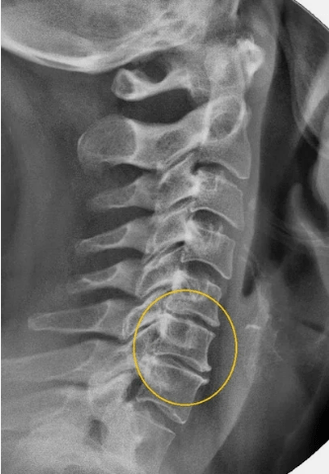 Osteocondrosi della colonna cervicale su un raggio X