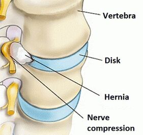 Osteocondrosi della regione di cervice