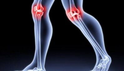 Prevenzione dello sviluppo dell'artrite e dell'artrosi