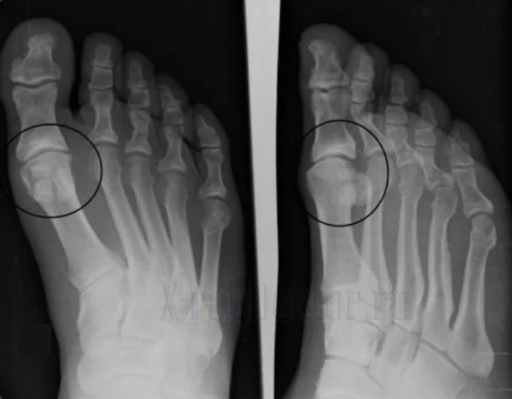 Diagnosi di osteoartrosi