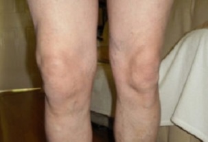 Manifestazioni di artrosi dell'articolazione del ginocchio (1)