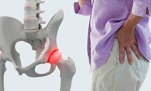 Cause dell'osteoartrosi dell'articolazione dell'anca