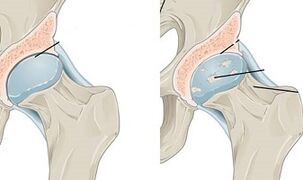 Stadi di sviluppo dell'osteoartrosi dell'anca