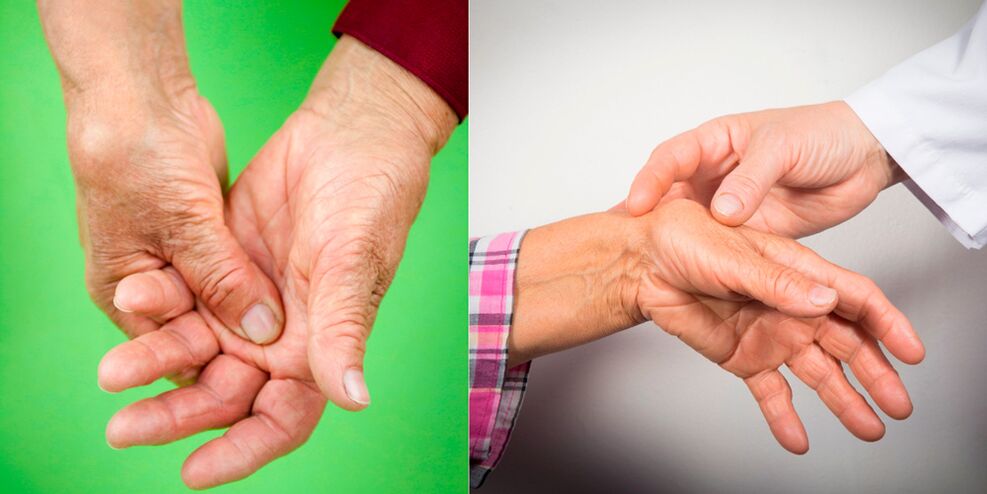 Gonfiore e dolore dolorante sono i primi segni di artrosi della mano