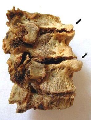 Sezione delle vertebre colpite da osteocondrosi
