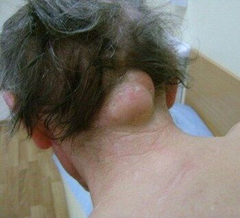 Neoplasie come causa di dolore al collo