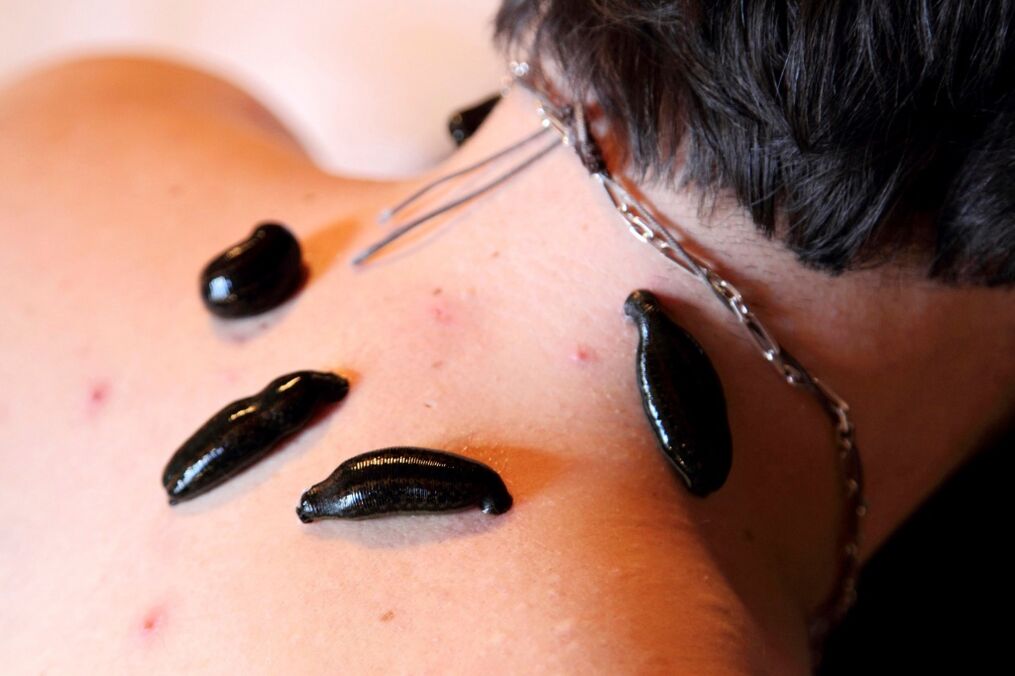 Sanguisughe per l'osteocondrosi cervicale