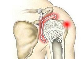 Distruzione dell'articolazione della spalla con artrosi