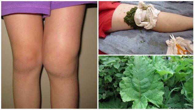 Impacco alle erbe per l'artrosi del ginocchio