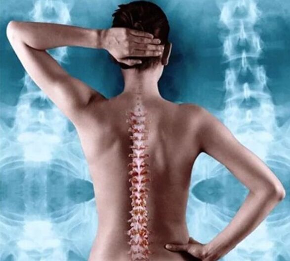Osteocondrosi della colonna vertebrale e del torace