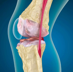 L'artrosi del ginocchio