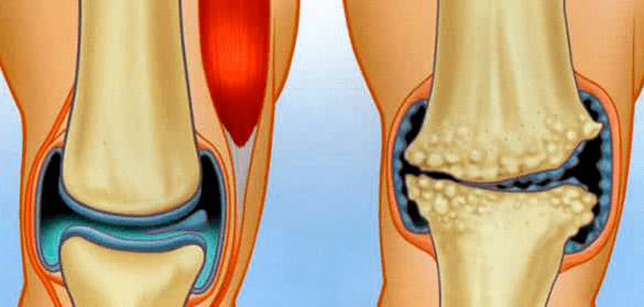 Normale articolazione e osteoartrosi
